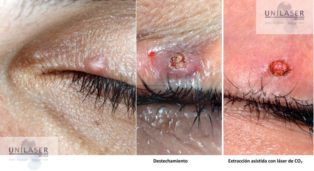 Extracción quiste epidermoide palpebral