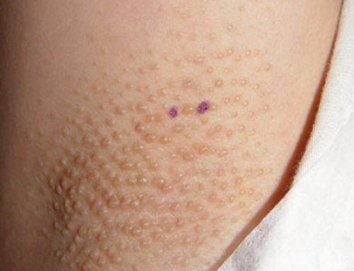 Milaria apocrine and laser