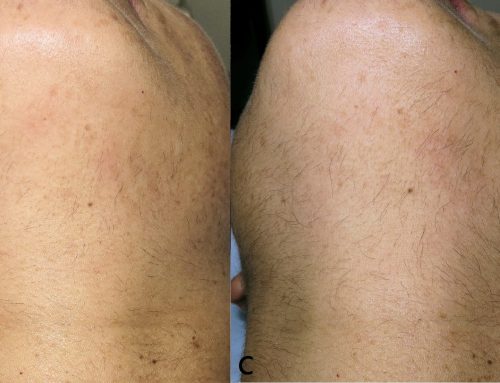 Hypertrichosis paradoxical by laser for hair removal