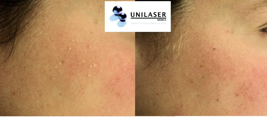 Destechamiento, vaporización de microcapsulas asistida con láser y microscopio