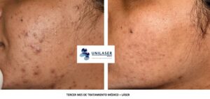 Acné del adulto tratado con láser