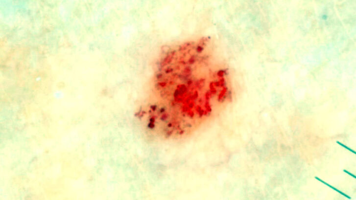 Nevus rubí, angioma cherry, nevus cereza