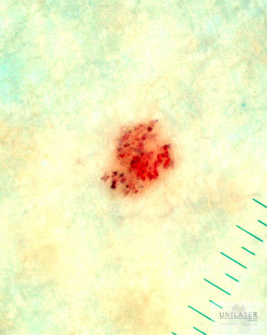 Nevus rubí, angioma cherry, nevus cereza
