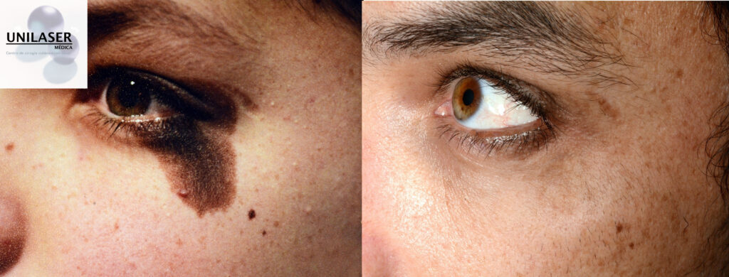 Nevus de conjunción palpebral tratado con láser