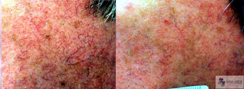 Dilataciones faciales densas de la mejilla
