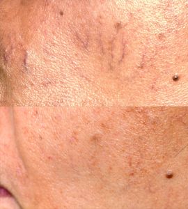 Primelase para lesiones vasculares de la cara