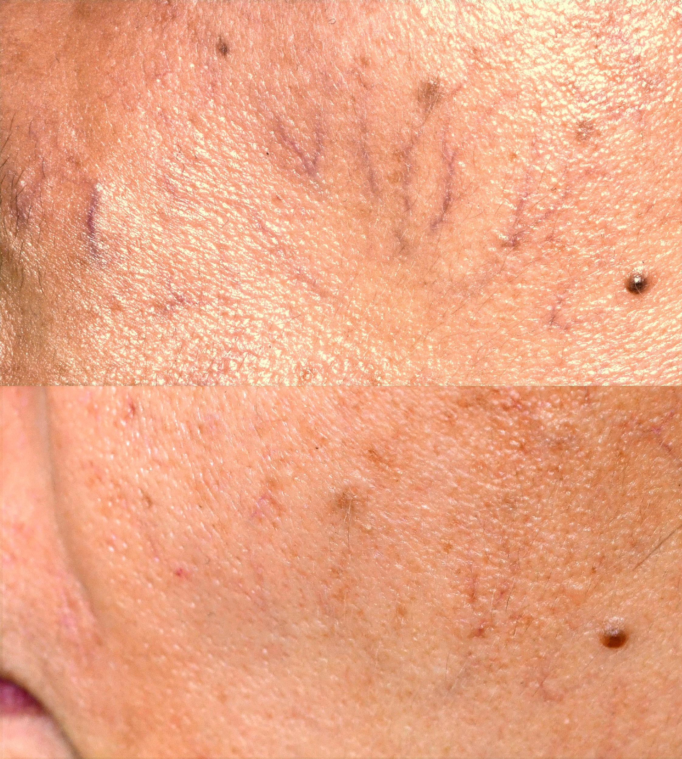 Primelase para lesiones vasculares de la cara