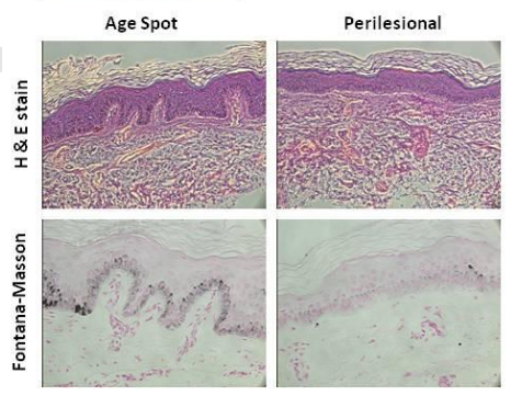 Lentigines are more than just spots