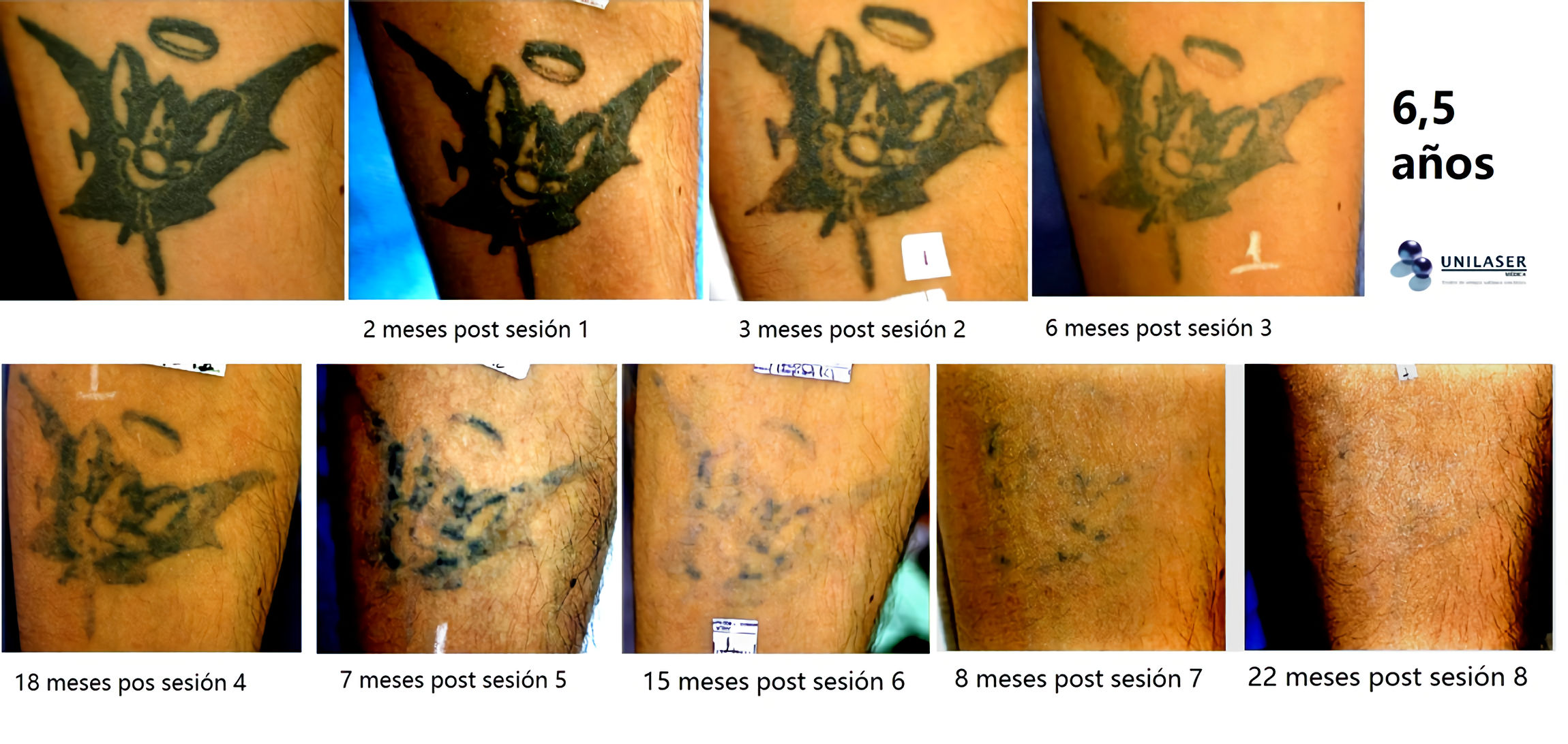 laser tatuajes