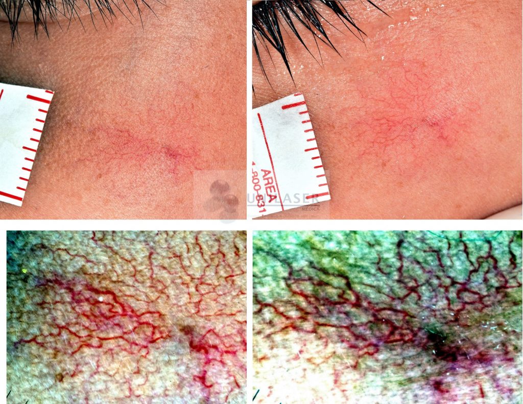 segunda sesión láser vascular nevus en araña