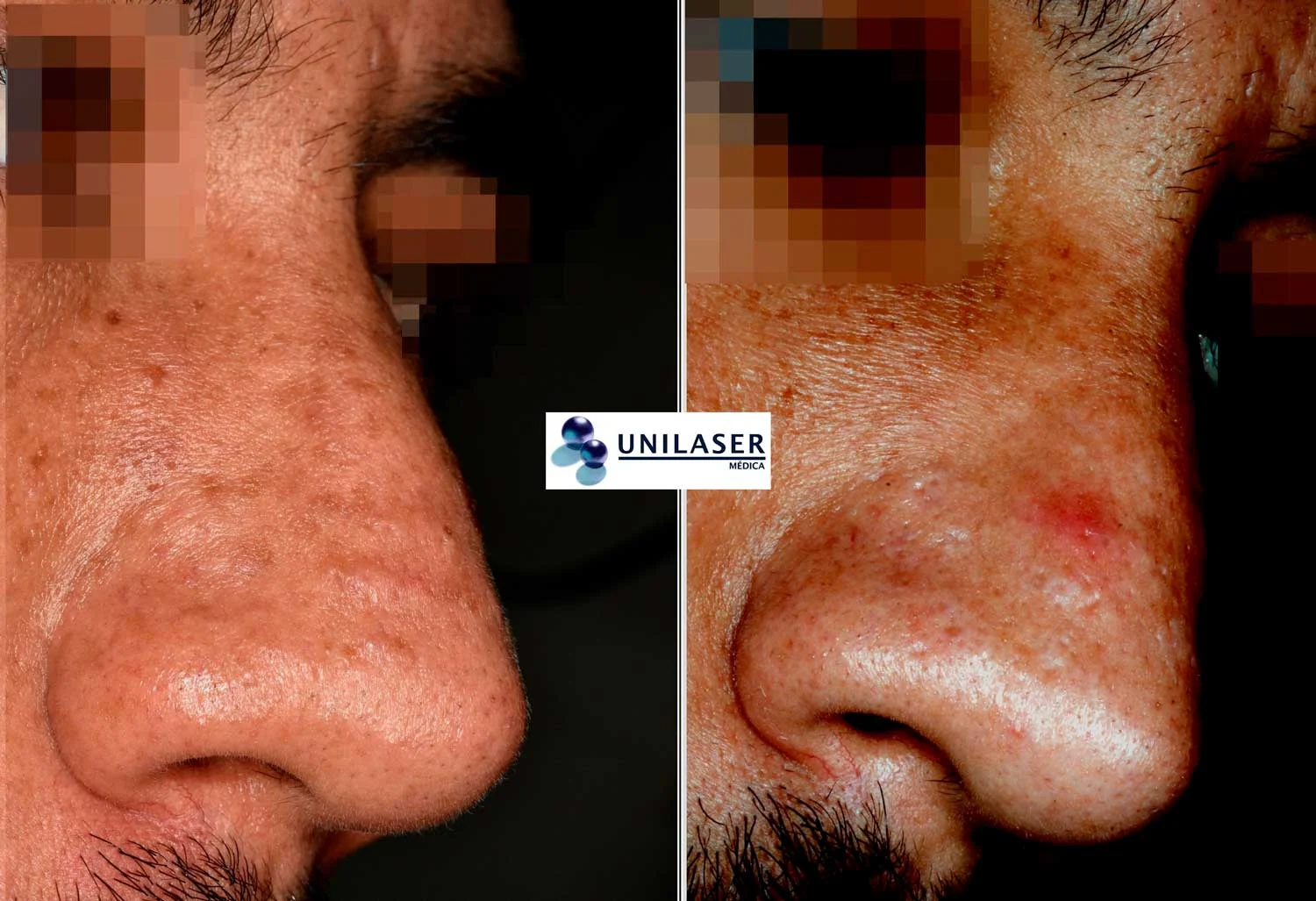 Cicatrices papulares del dorso nasal. Control 6 meses después de completar 6 meses de tratamiento.