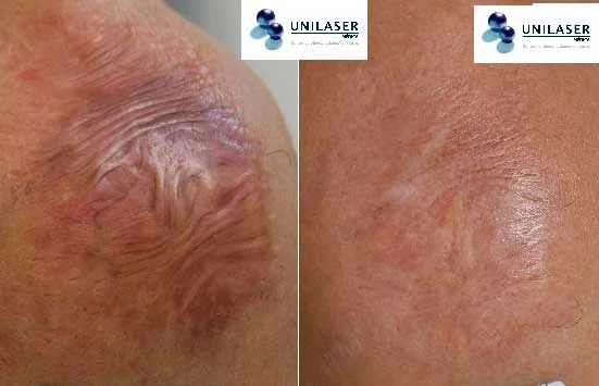 Cicatriz madura en rodilla con mejoría progresiva tras manejo fraccionado seriado y seguimiento de largo plazo.