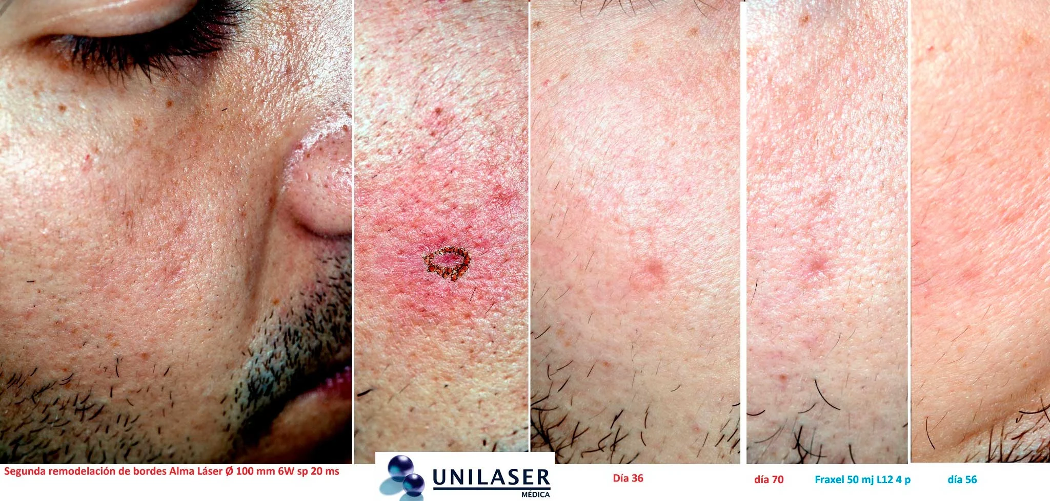 Evolución de una cicatriz facial focal tratada con remodelación selectiva de bordes y complemento posterior con láser fraccionado, con controles seriados.
