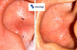 acné que no mejora en concha auricular, tratamiento láser
