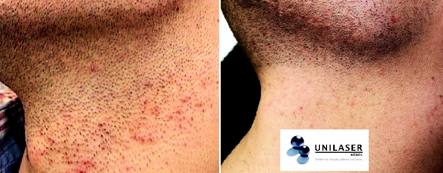 Depilación láser de la barba