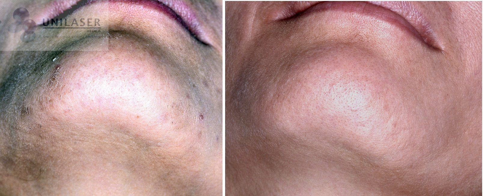 psudofoliculitis tratada con láser