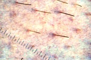 Dermatoscopia incial pelos en piernas
