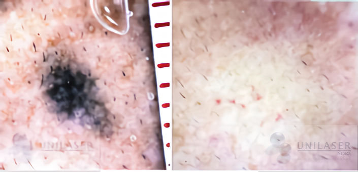 Efecto inmediato de aclaración por combustión de tinta de láser conmutado