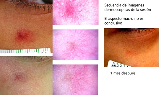 Araña vascular
