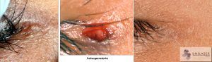 Tratamiento hidrocistoma