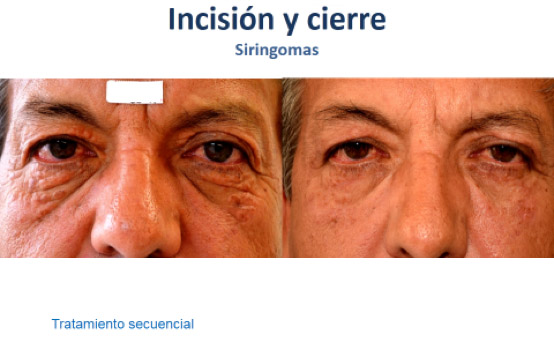 Siringomas Microcirugía para siringomas