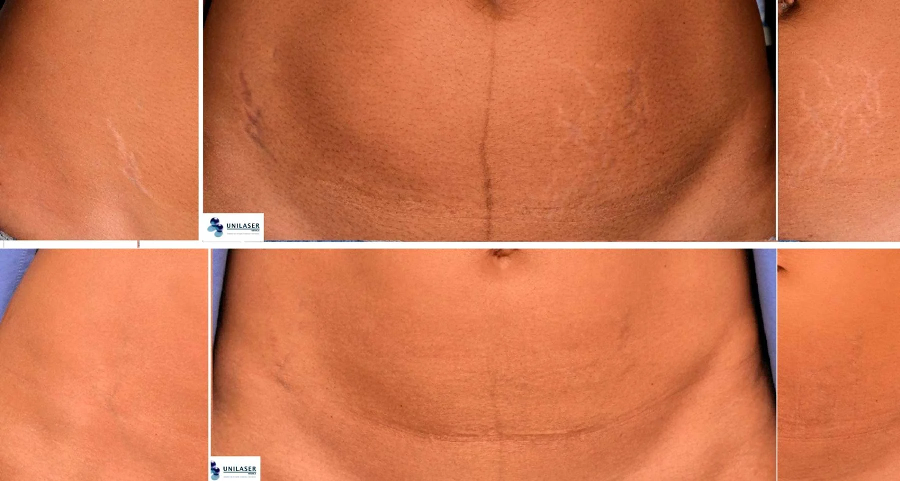 Estrías abdominales bilaterales. Comparación clínica de la misma paciente, mostrando mejoría en el contraste y en la visibilidad de las estrías, especialmente en los flancos y en la parte baja del abdomen.