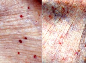 Milesman Nevus Rubí en piel de una mujer de 90 años