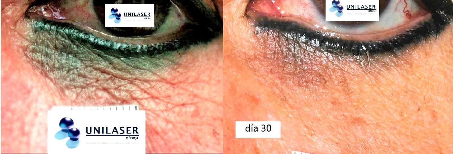Fanning por maquillaje permanente periocular: comparación inicial y control al día 30 después del tratamiento.