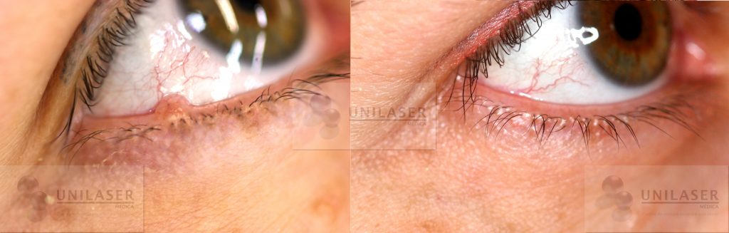 Otro ejemplo de la resección de un nevus del borde libre del párpado en donde se evitó la resección quirúrgica