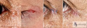 hidrocistoma del párpado