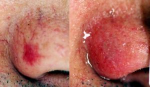 Efecto de la IPL en una lesión vascular amplia