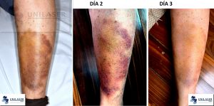 luz roja para eliminar hematomas