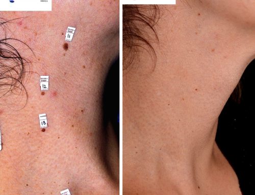 He laser for the moles of the neck