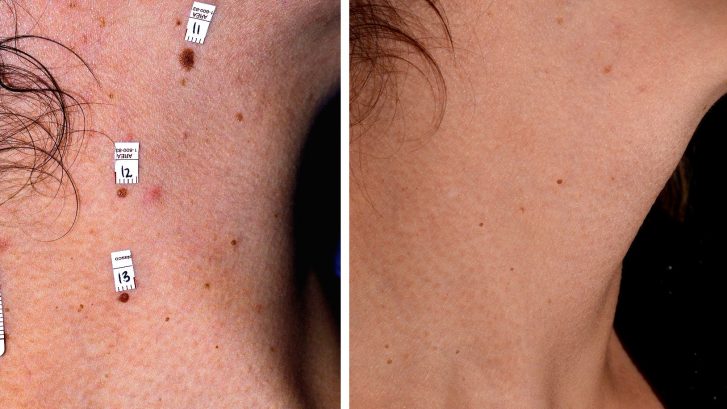 eliminación lunares del cuello