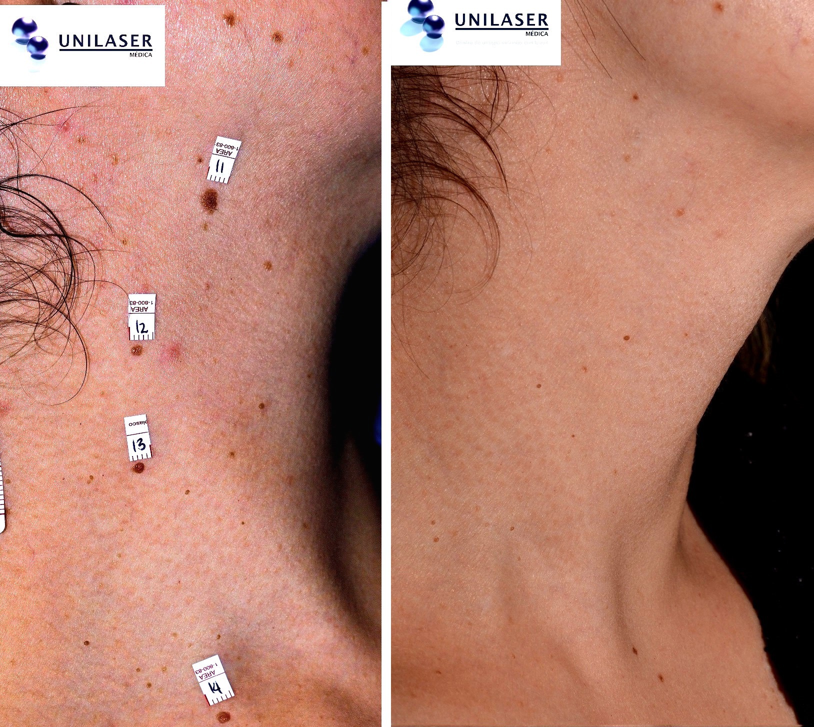 eliminación lunares del cuello