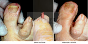 CO2 laser for ungrown toenail
