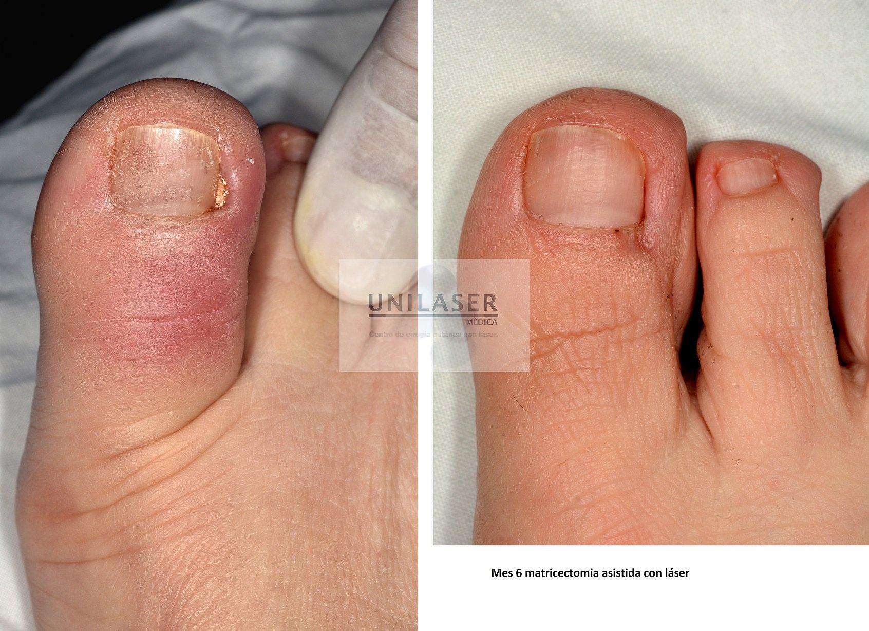 Ungrown toenail
