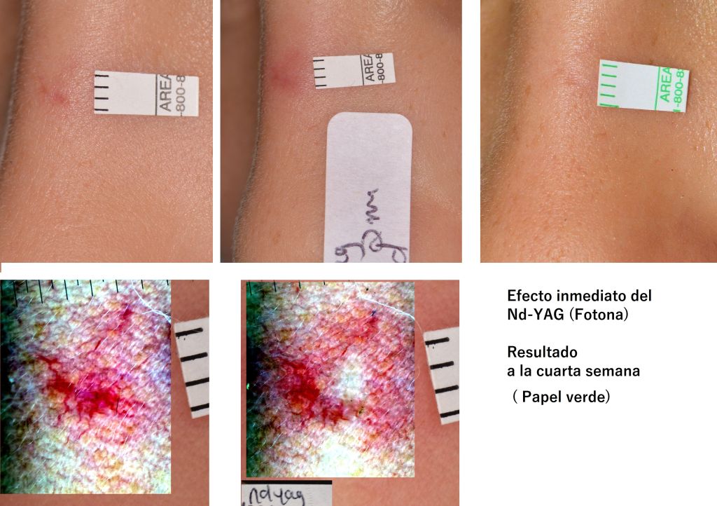 Spider Nevus tratado con Nd YAG