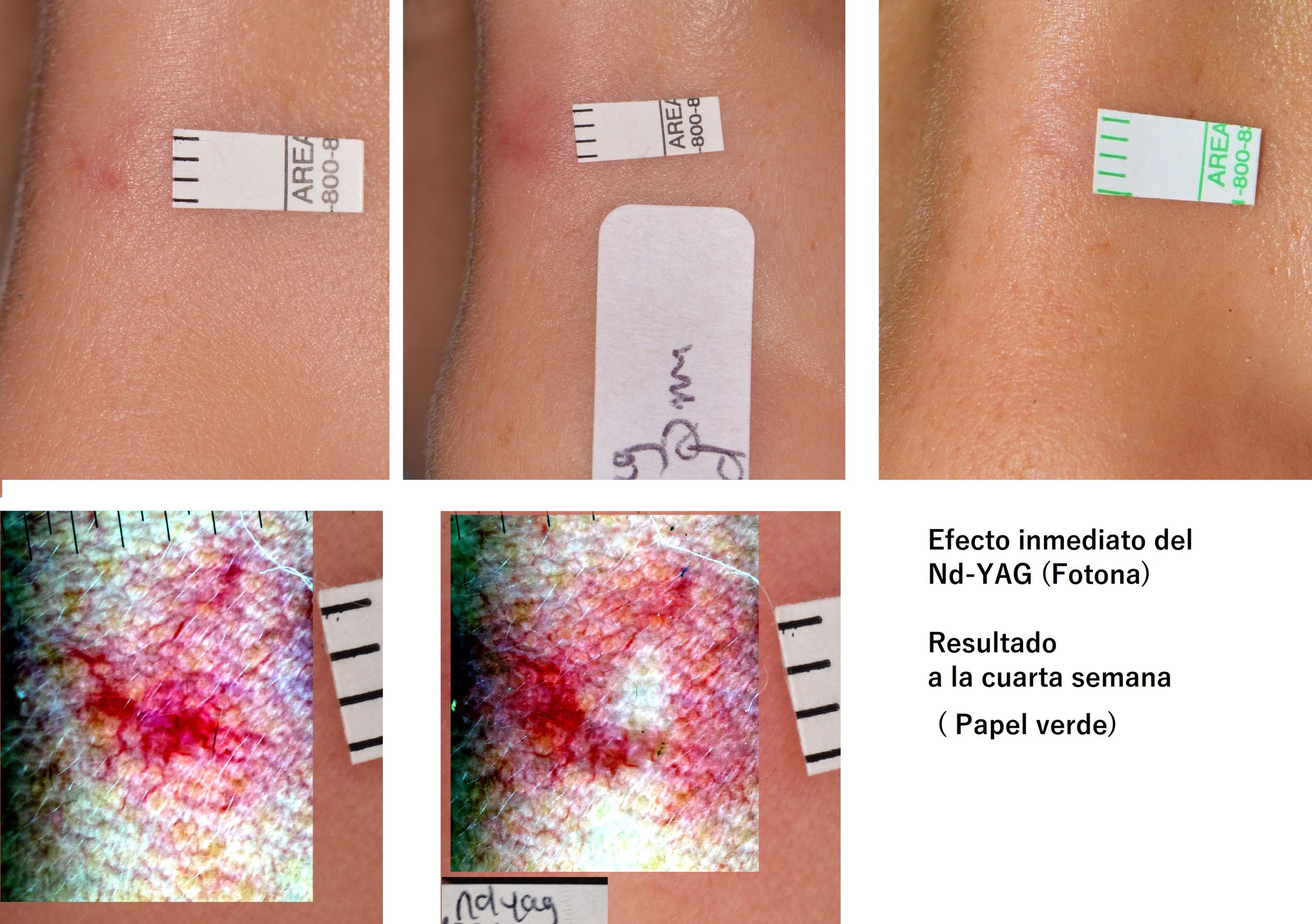 Spider Nevus tratado con Nd YAG