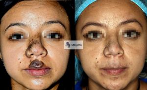 Nevus congénito de la cara tratado con láser