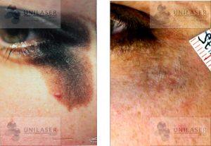 Nevus de conjunción palpebral tratado con láseres