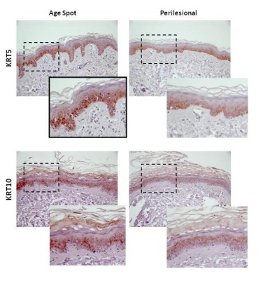 Histochemistry of lentigines