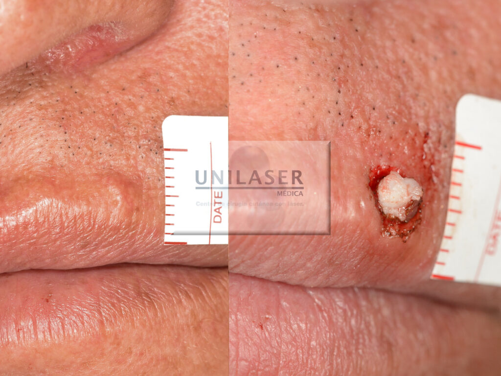 Resección quiste epidermoide del labio con láser