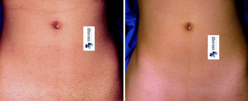 Depilación láser del abdomen