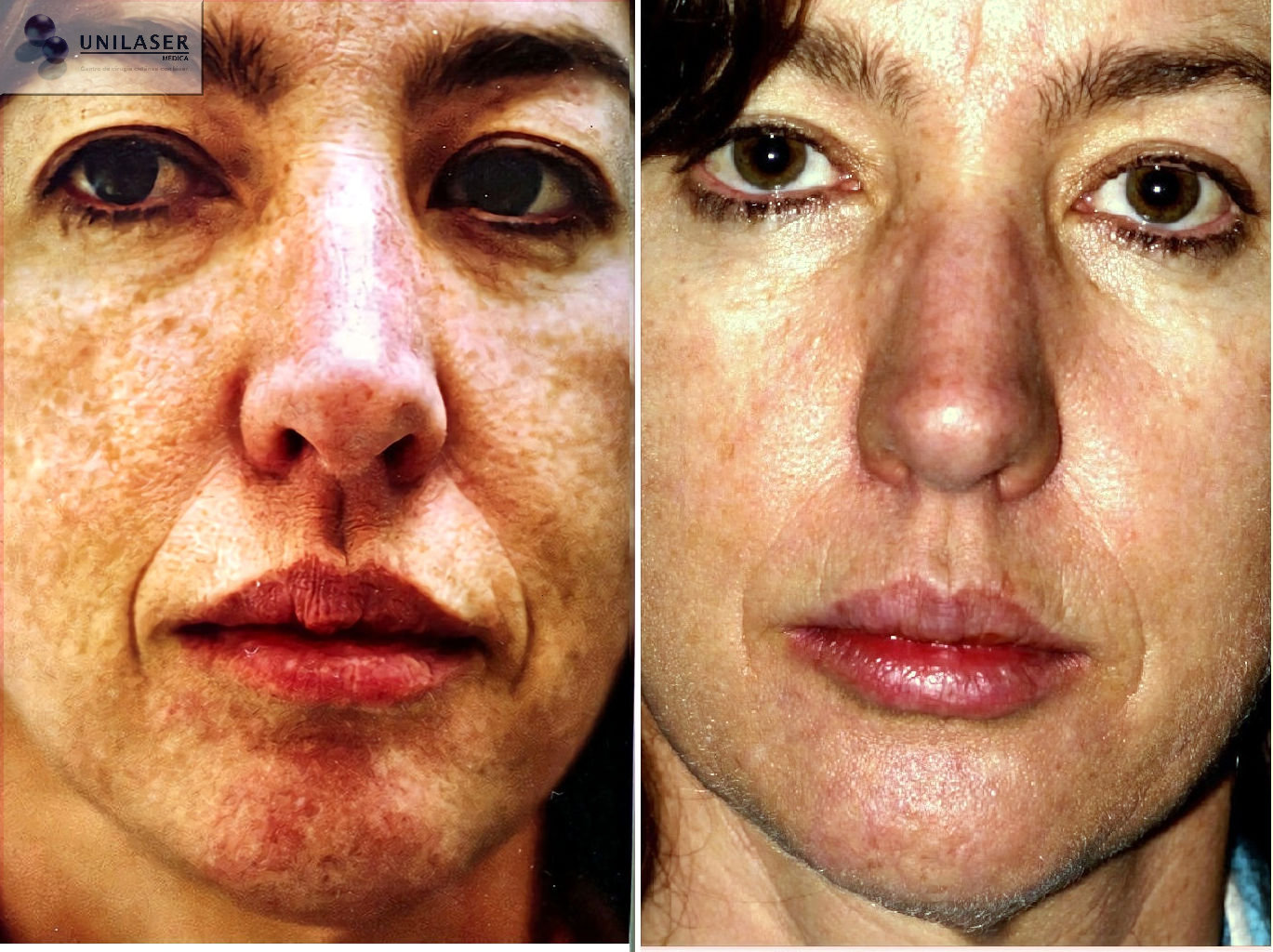Laser treatment results for facial photodamage