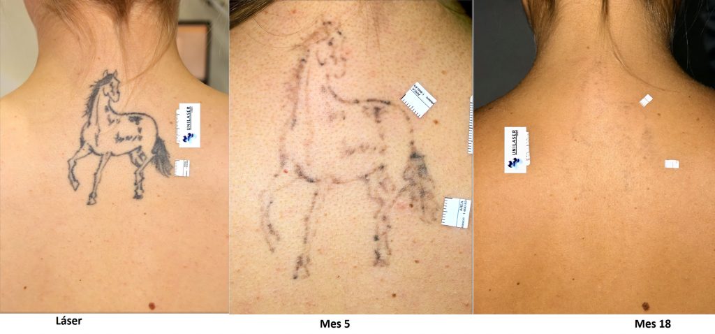 remoción de tatuajes