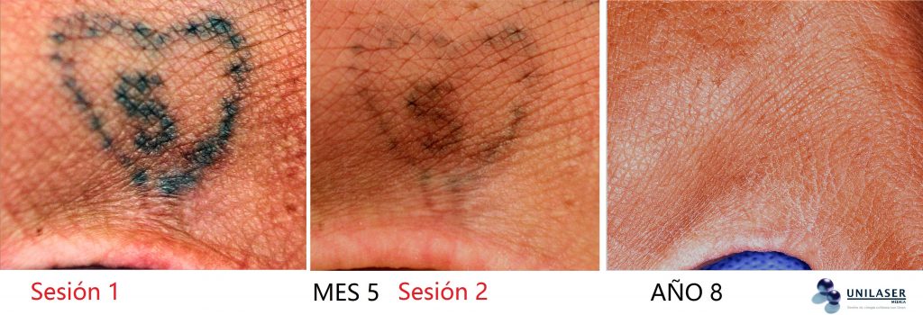 Tatuaje pequeño con mediana cantidad de tinta tratado con dos sesiones láser. Posterior a 5 años no se observa