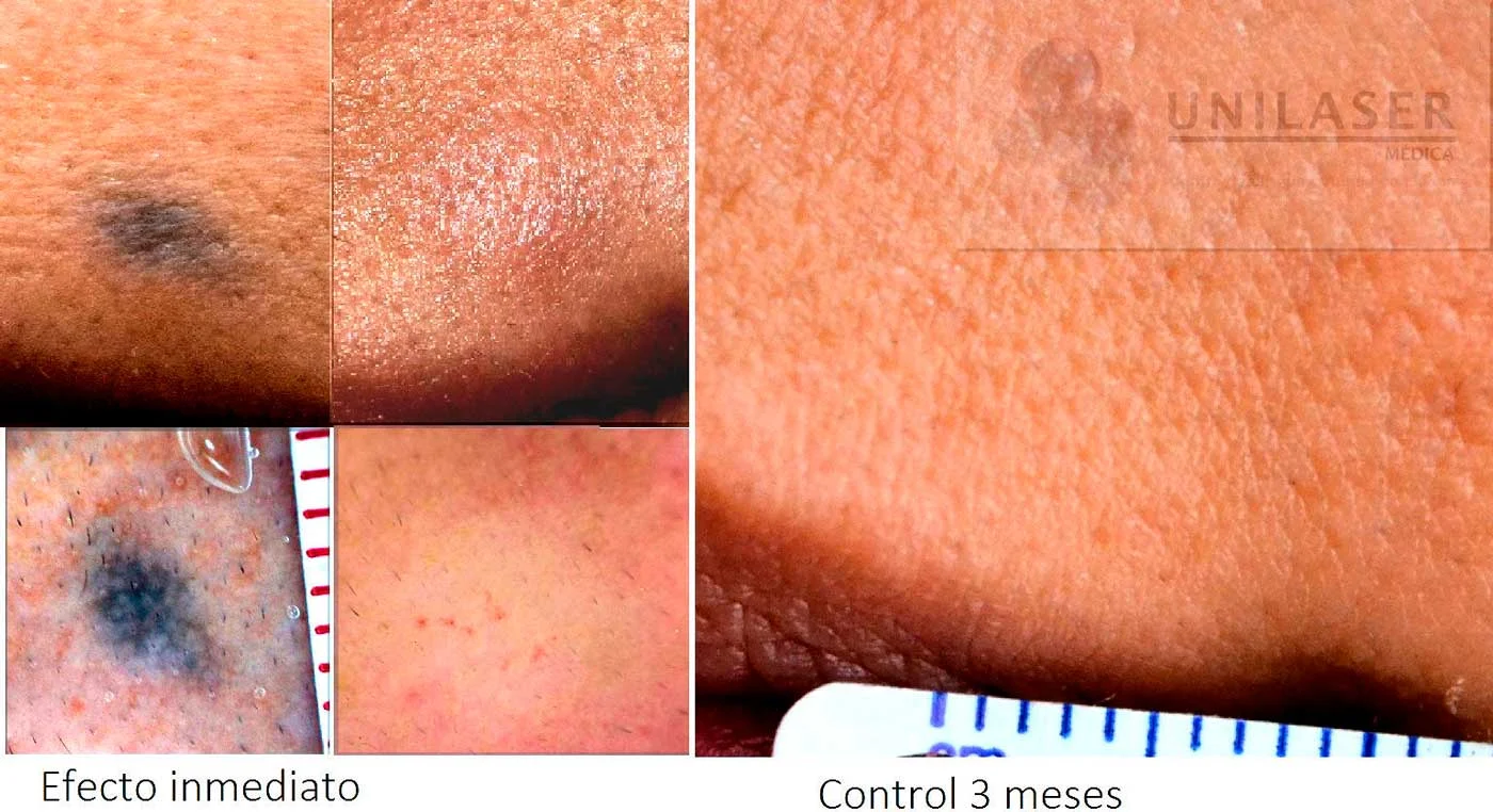 Tatuaje con baja carga de pigmento: aclaramiento visible inmediatamente después del láser y evolución adicional durante los tres meses siguientes.