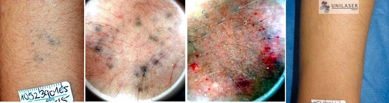 Tatuaje con baja carga de pigmento. Las imágenes centrales muestran la dermatoscopia antes y después del tratamiento; en el control final el pigmento deja de ser visible clínicamente.