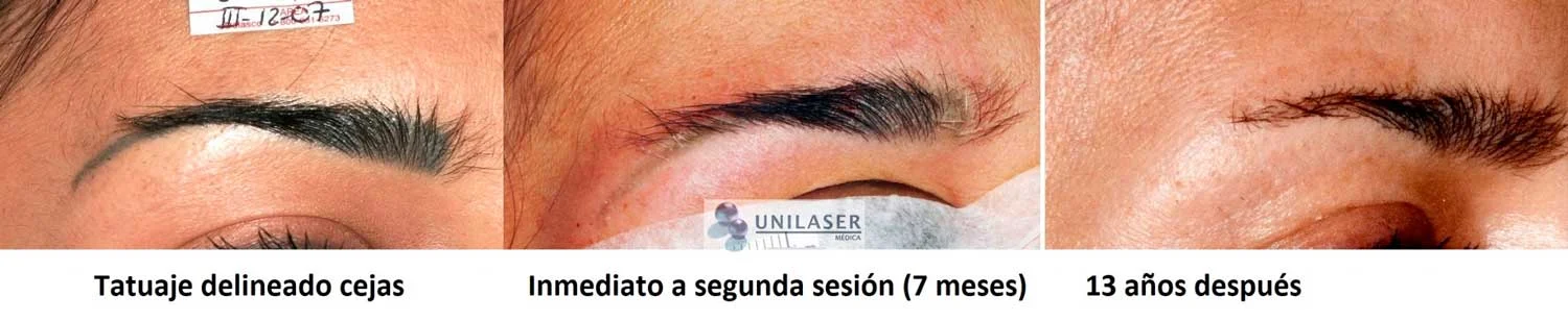 Tatuaje cosmético de cejas. Tratamiento en dos sesiones separadas por 7 meses y control 13 años después, con persistencia del aclaramiento a largo plazo.